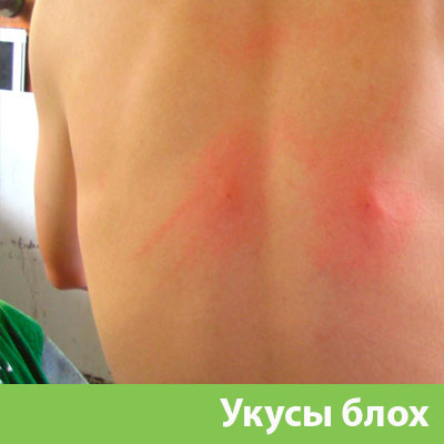 Укусы блох в Чебоксарах