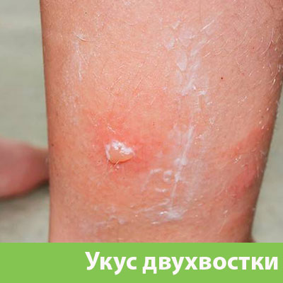 Укус двухвостки в Чебоксарах