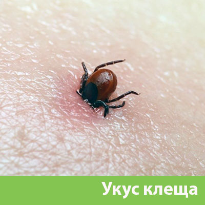 Укус клеща в Чебоксарах