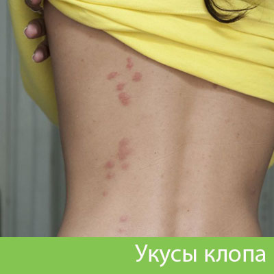 Профессиональное уничтожение клопов в Чебоксарах